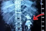 Cô gái trẻ nhập viện, bác sĩ phát hiện hai bên thận chi chít sỏi vì món đồ uống yêu thích